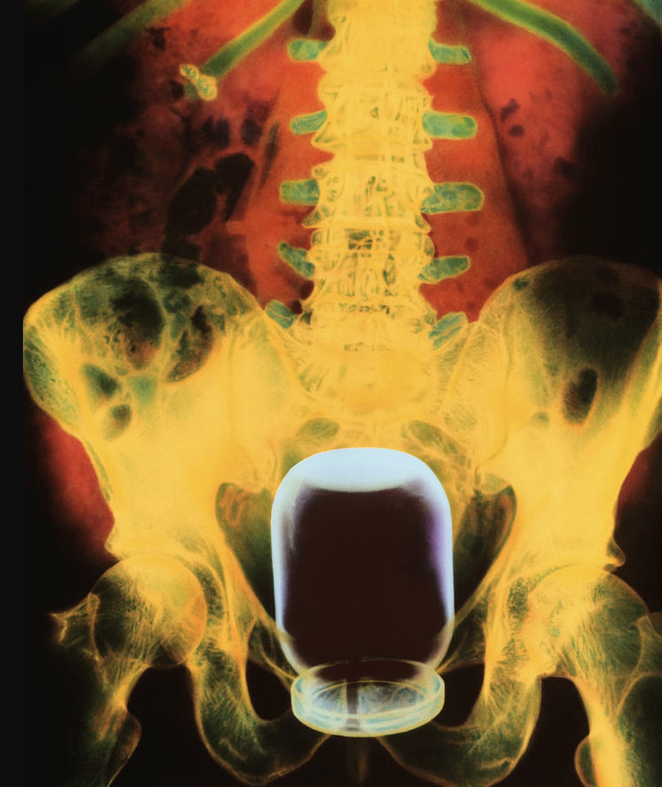 jar in rectum xray